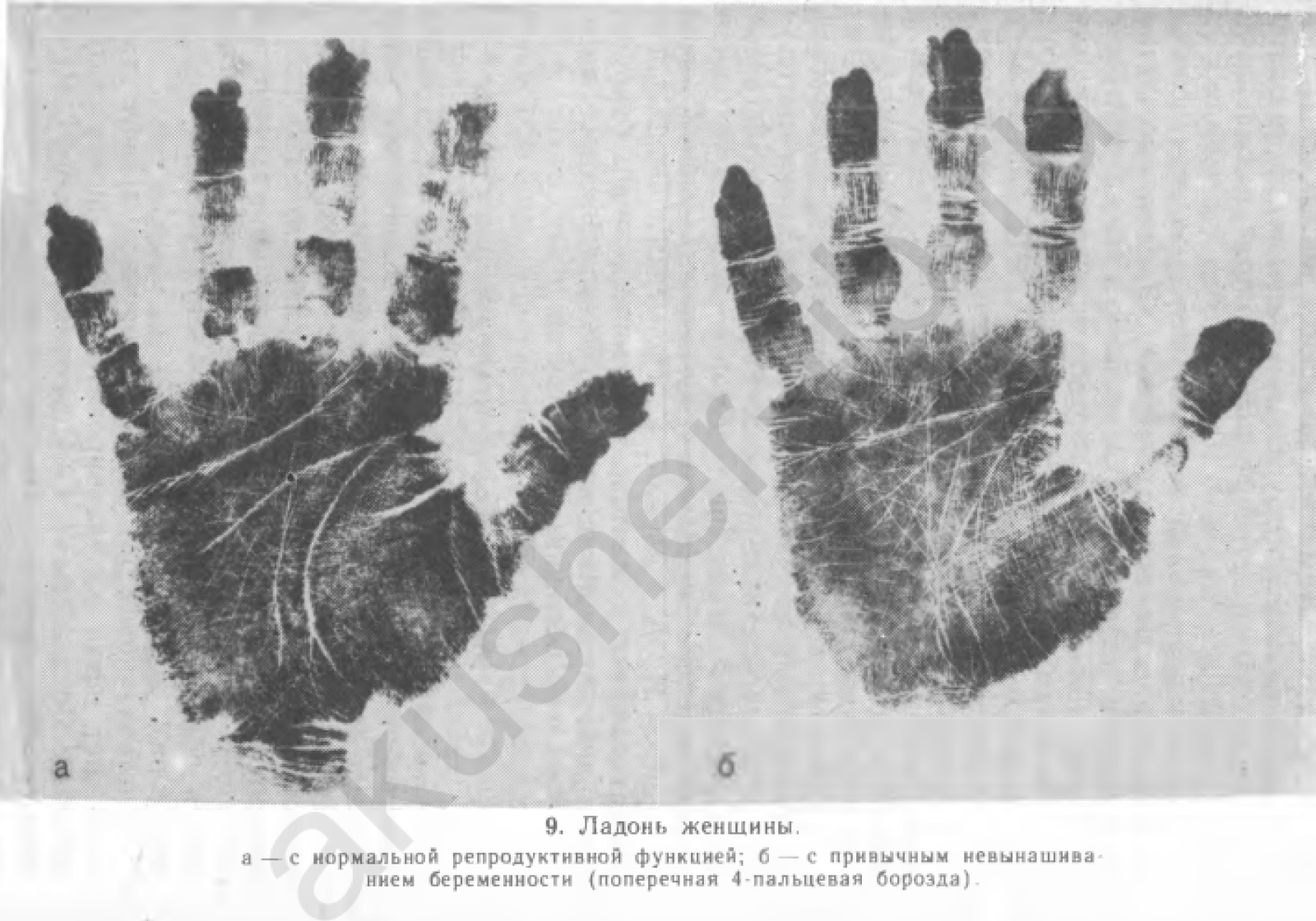 Иллюстрация индивидуальных различий у пациенток с привычным невынашиванием — состоянием, при котором беременность неоднократно самопроизвольно прерывается. Источник: Сидельникова В. М. «Невынашивание беременности». Медицинское информационное агентство, 2016. Иллюстрация индивидуальных различий у пациенток с привычным невынашиванием — состоянием, при котором беременность неоднократно самопроизвольно прерывается. Источник: Сидельникова В. М. «Невынашивание беременности». Медицинское информационное агентство, 2016.